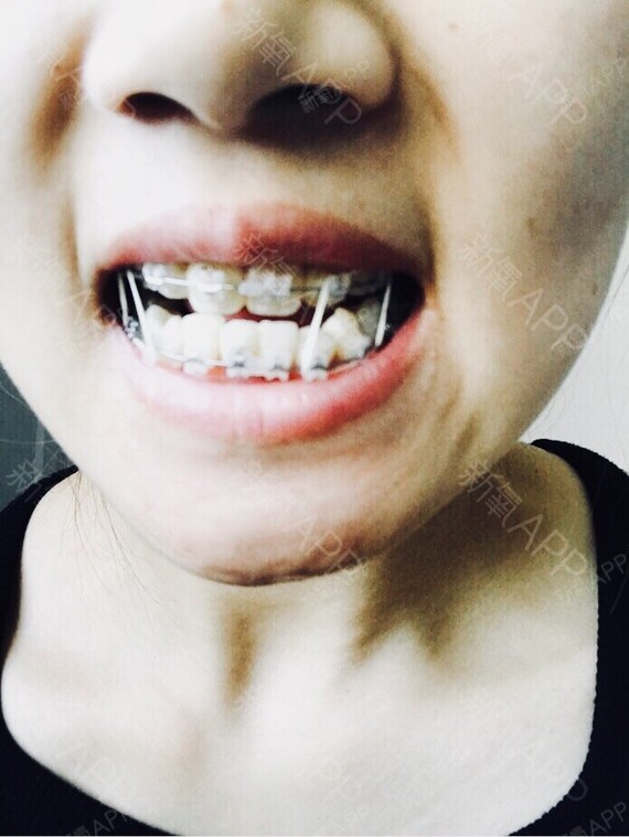 牙齿变化比较大的,现在整齐之后拆牙套后我会给牙齿美白,将蛀牙什么的
