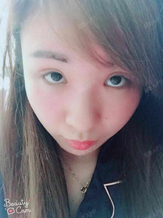 男生们是非开内眼角第52天美丽日记-新氧美容