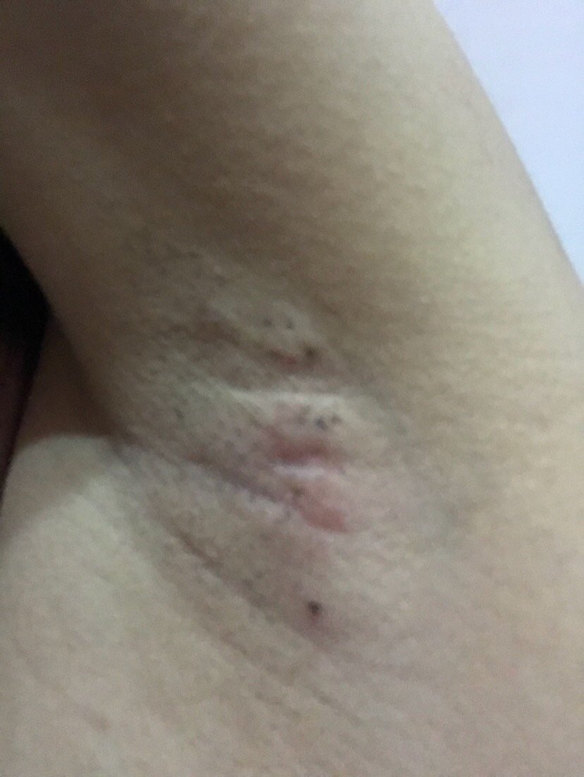 我看叫冰点疼死人脱毛还差不多做腋下的时候疼的连亲妈_圈子-新氧美容
