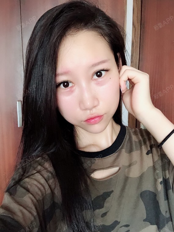 笨蛋熊眶隔脂肪释放第1天美丽日记-新氧美容整