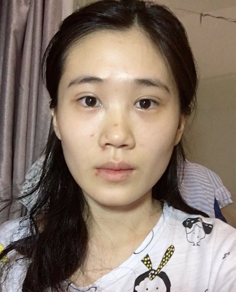 广州缔妍医疗美容开内眼角怎么样_恢复过程_效果如何
