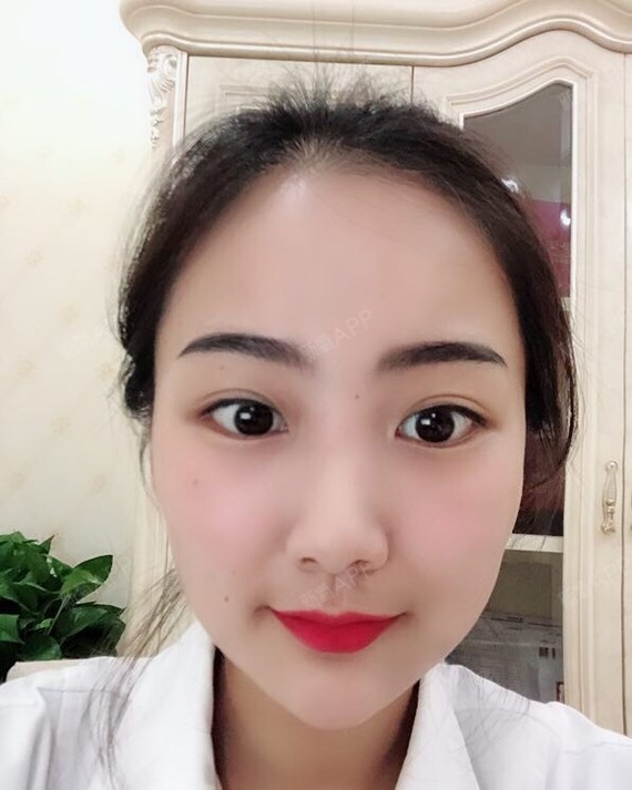 新氧-瘦脸8125611526451152|鸡胸还是|瘦脸|肉轮廓氧气|术后水煮面部减脂毒素增肌图片