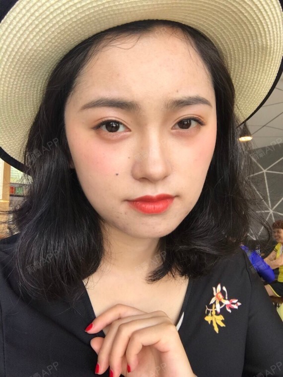 【昆明韩辰】双眼皮是要宽一点,还是要窄一点?