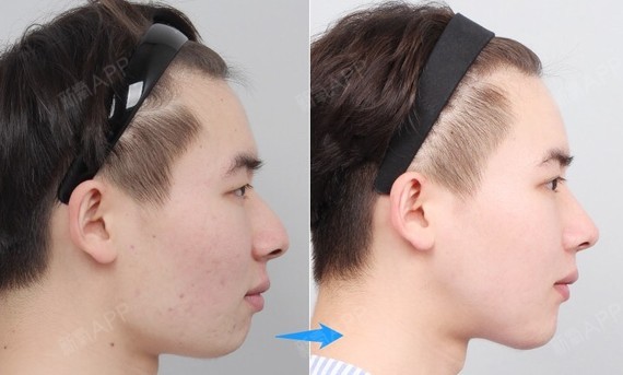 国还是中国,整形目前不仅是女性的专利,男性也