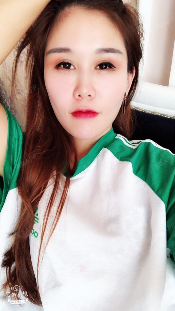 小馒头旺仔的自体脂肪丰太阳穴第501天美丽日记