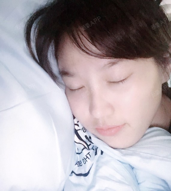 后简o开内眼角第586天美丽日记-新氧美容整形