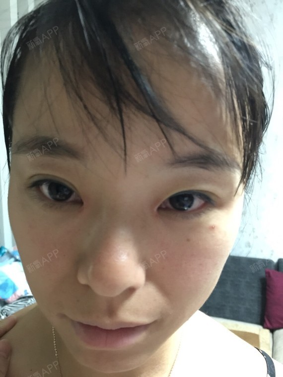 男生们是非开内眼角第20天美丽日记-新氧美容