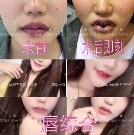 m唇手术