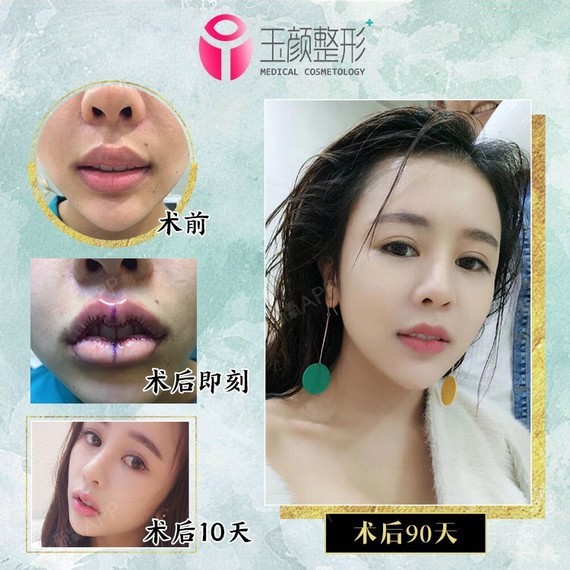 那我们这边可以看下做厚唇改薄改善的宝宝
