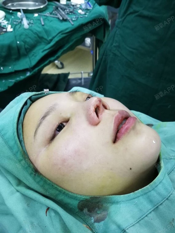 成都鼻部美容整形多少钱