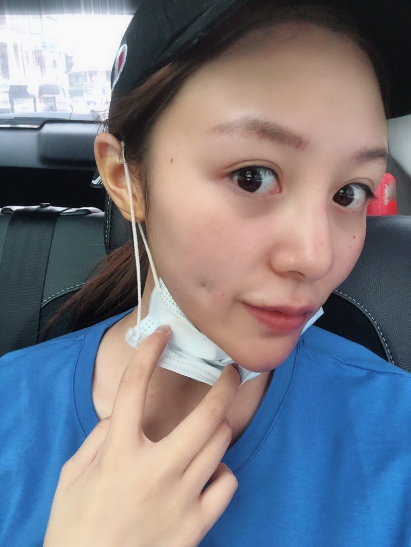 大家好,我来写日记啦,刚刚做了酒窝埋线手术,我真是既激动又兴奋啊