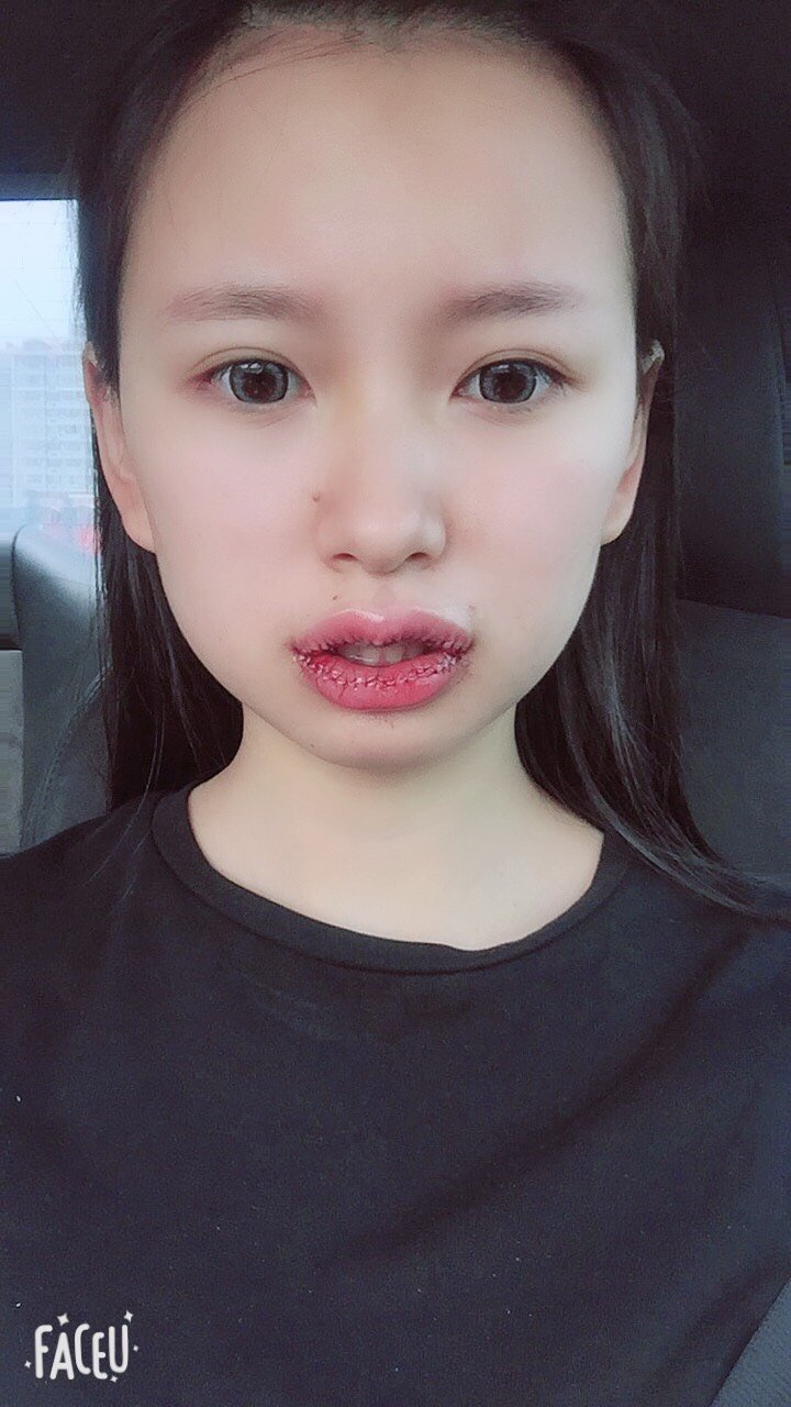 m唇手术第0天
