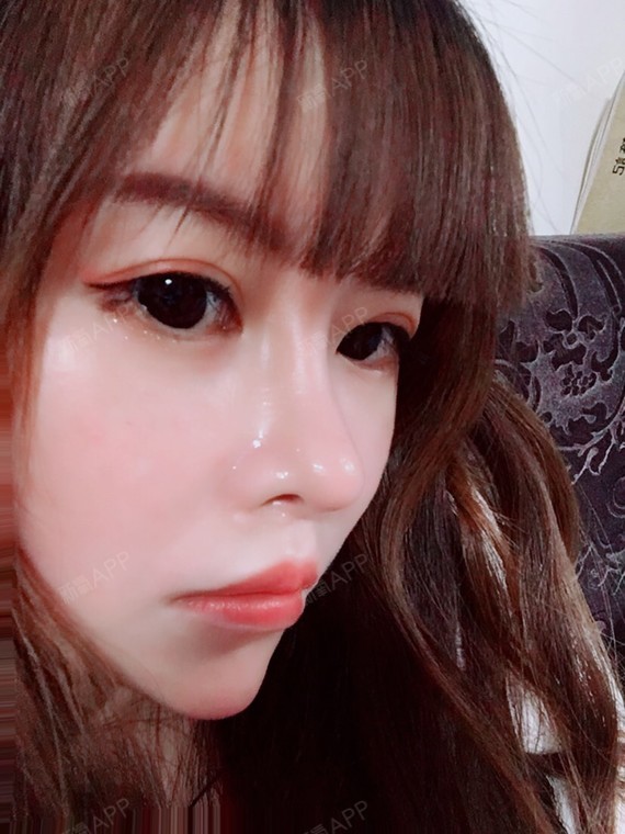 爱美的兔子520人中缩短术术后第158天美丽日记_新氧