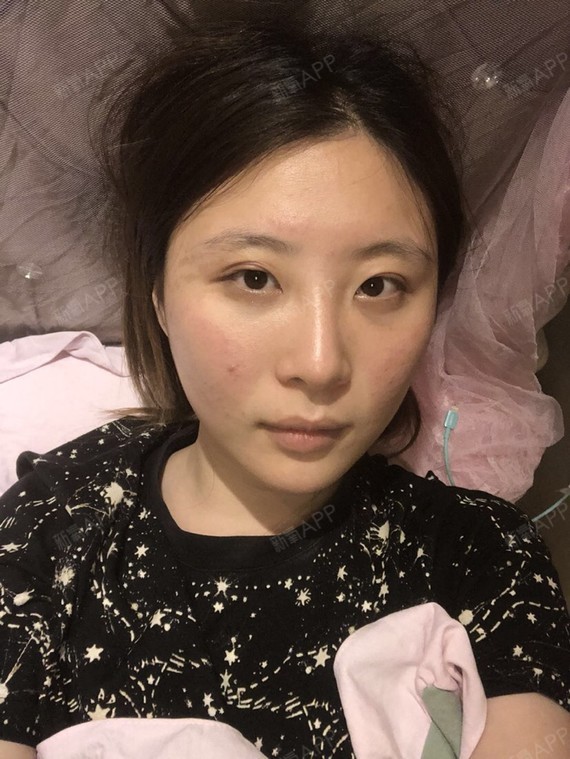 我是你的小心肝啊肋软骨隆鼻第0天美丽日记-新