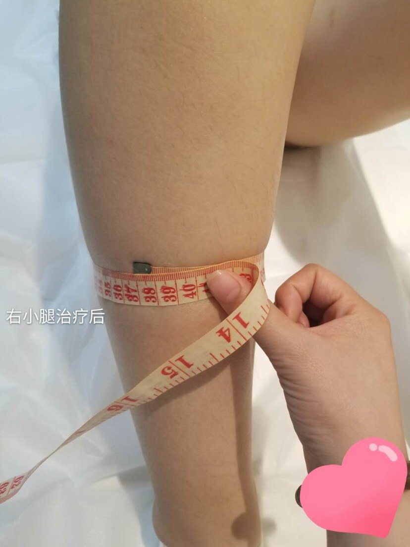 射频溶脂瘦小腿第0天
