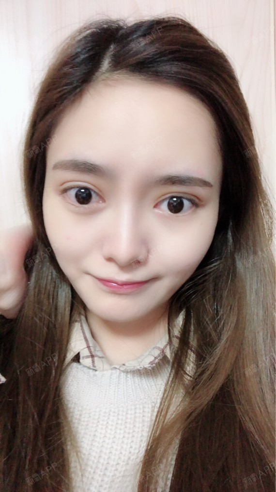 【美莱整形】除狐臭的作用效果肉毒素治疗狐臭