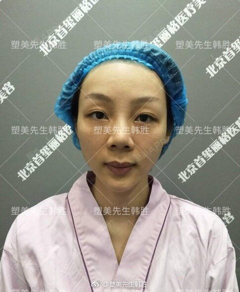 这个个性术前面部头像松弛下移女生肌导致,整姑娘皮肤网短发苹果图片