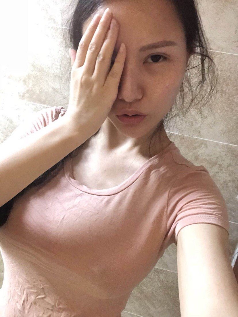 重庆华美整形美容医院假体隆胸怎么样?_sugar111美丽