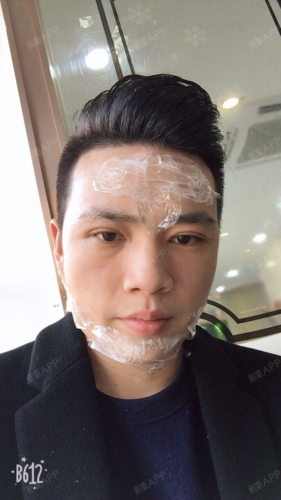 第七天去拆线,顺便打瘦脸针,玻除皱,瘦腿针ltyss尿酸裤图片