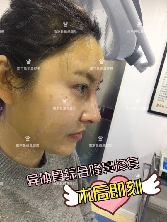 原来鼻子没有弧度,很没气质,做完肋软骨鼻部多项之后,真是自信了很多