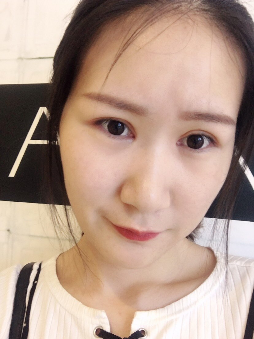 组织恢复期开内眼角第65天           ·           第9篇日记