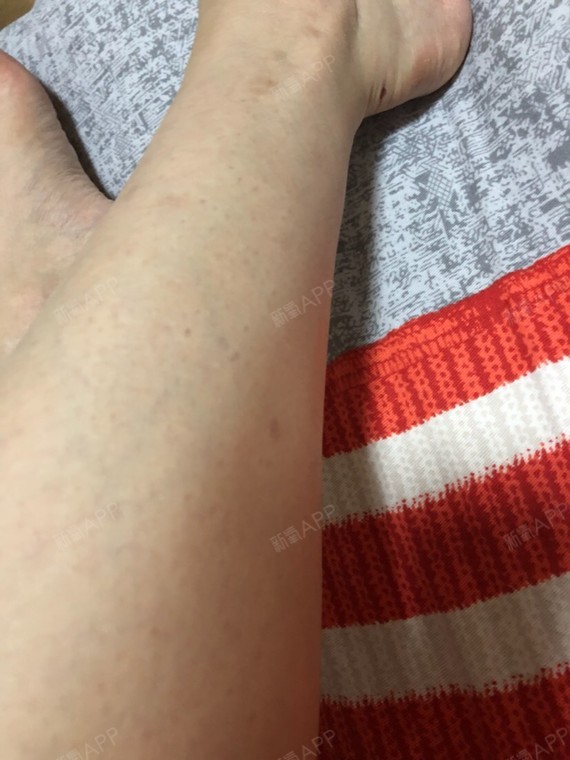 激光脱毛第0天,小腿刚脱完还有小红点,估计过一段时间还会再长出来点.