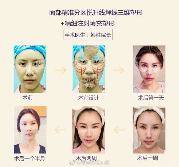 面部精准分区悦升线埋线三维塑形 精细注射填充术后一