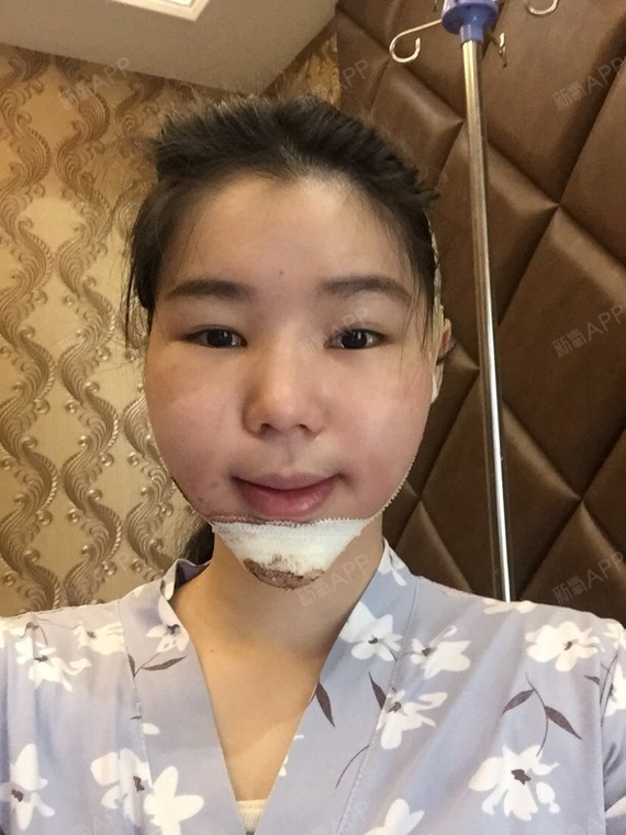 最后上个做了假体下巴的图.