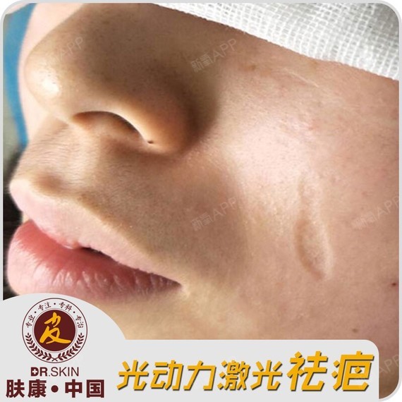 患者小然脸上有个一凹陷性疤痕,虽然不痛不痒,却十分影响美观,患者在