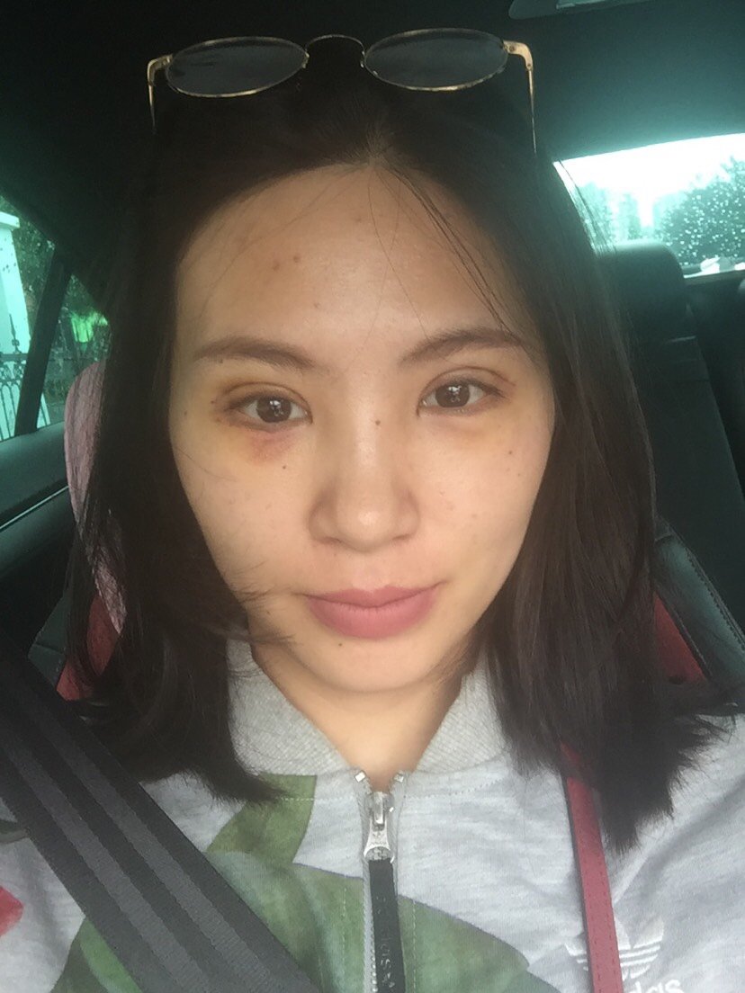 开内眼角第5天