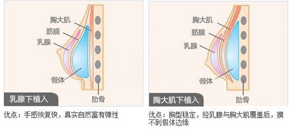 假体丰胸是世界上开展时间最长,经验最多的方法.将优