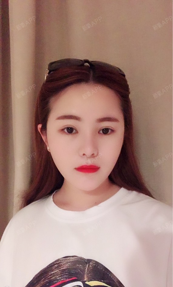 华丽每一天切开双眼皮第611天美丽日记-新氧美