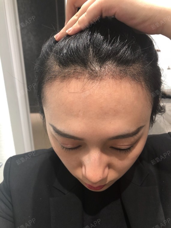 种植发际线