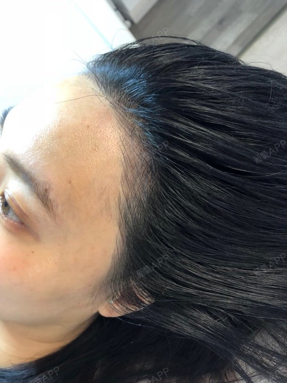半永久纹发际线