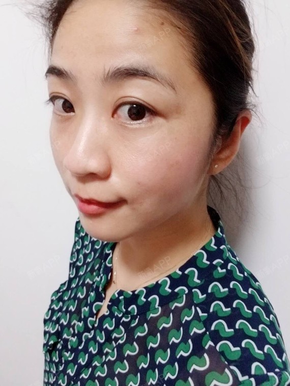 取颊脂垫瘦脸