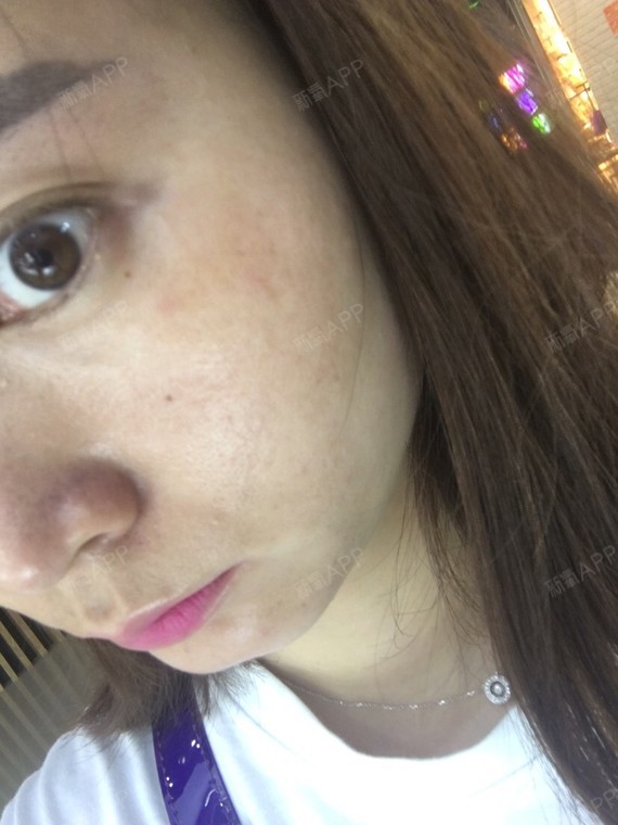 我的埋线双眼皮做了7年了最近发现眼角的地方有淤青!