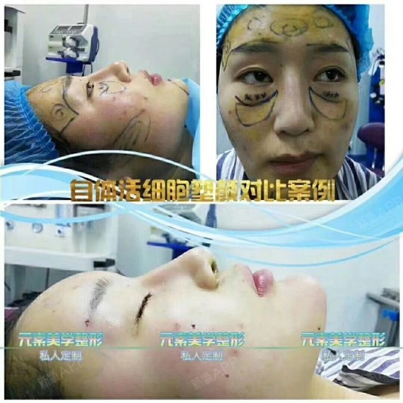 【郑州元素美学整形】自体脂肪填充可以维持多