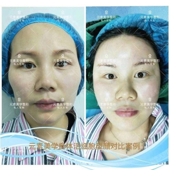 【郑州元素美学整形】自体脂肪填充可以维持多