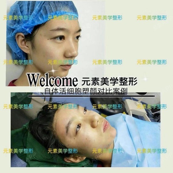 【郑州元素美学整形】自体脂肪填充可以维持多