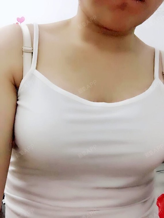 自体脂肪隆胸