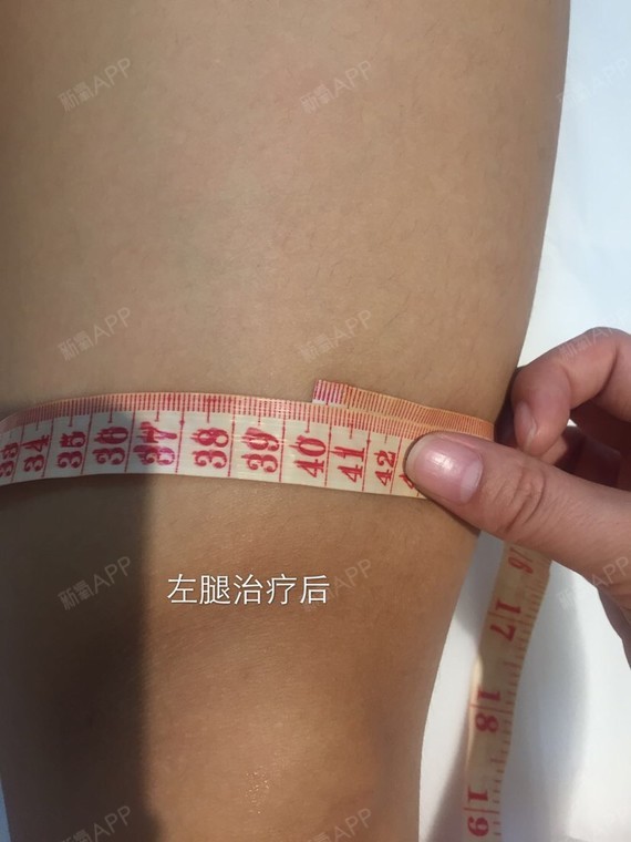 射频溶脂瘦腹部