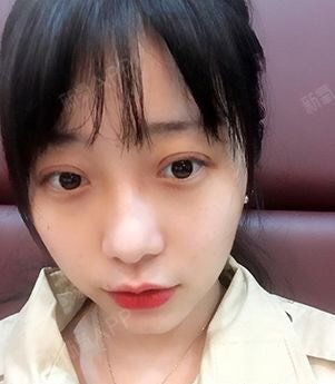 白人问号切开双眼皮第7天美丽日记-新氧美容整