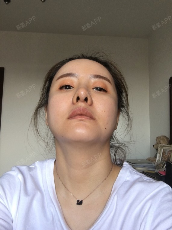 鼻骨矫正|沈阳同城|手术缩鼻头|手术缩鼻翼|鼻中隔软骨隆鼻
