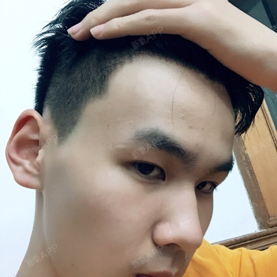 种植发际线