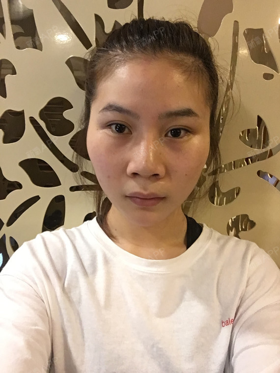 【鼻子做毁了可以修复吗】