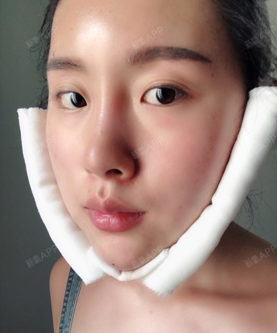 光纤溶脂瘦脸好不好_效果图_氧气g8e4091光纤溶脂瘦脸