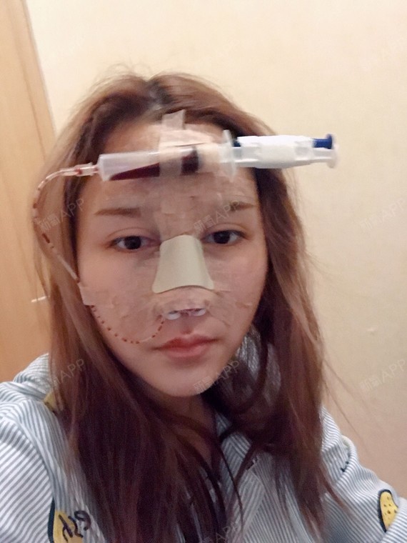 肋软骨隆鼻