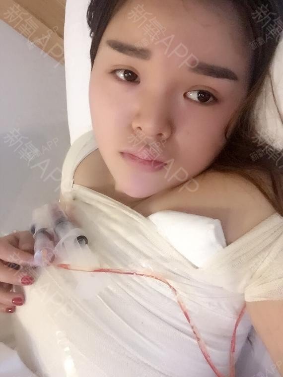 颖迩baby假体隆胸第3天美丽日记