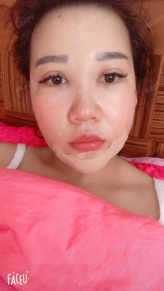 8号做的光纤溶脂假体下巴.今天13号了还是肿的