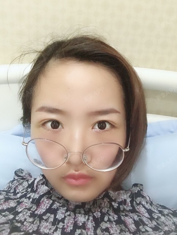 开外眼角